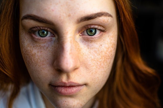 Freckles are natural pigmentation