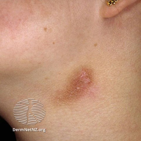 Post Inflammatory Hyperpigmentation