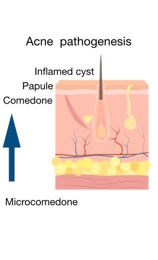 A 3-Step Skincare Routine for Acne: A Revolutionary Approach - Science ...